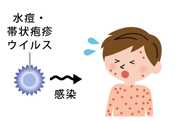 水ぼうそう　　 全身に発疹・痛み