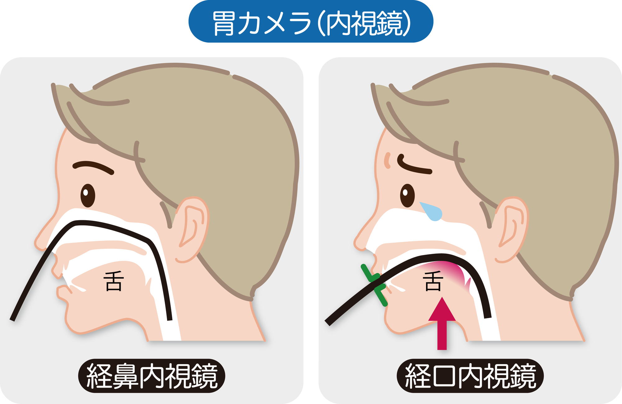 鼻 から 胃 カメラ 入ら なかっ た